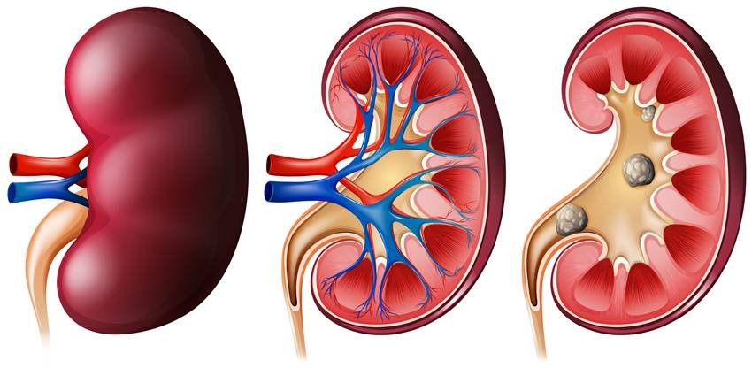 Six foods Kidney stone