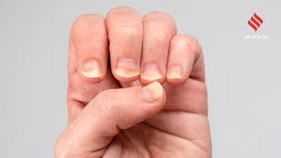 Nail health and hygiene