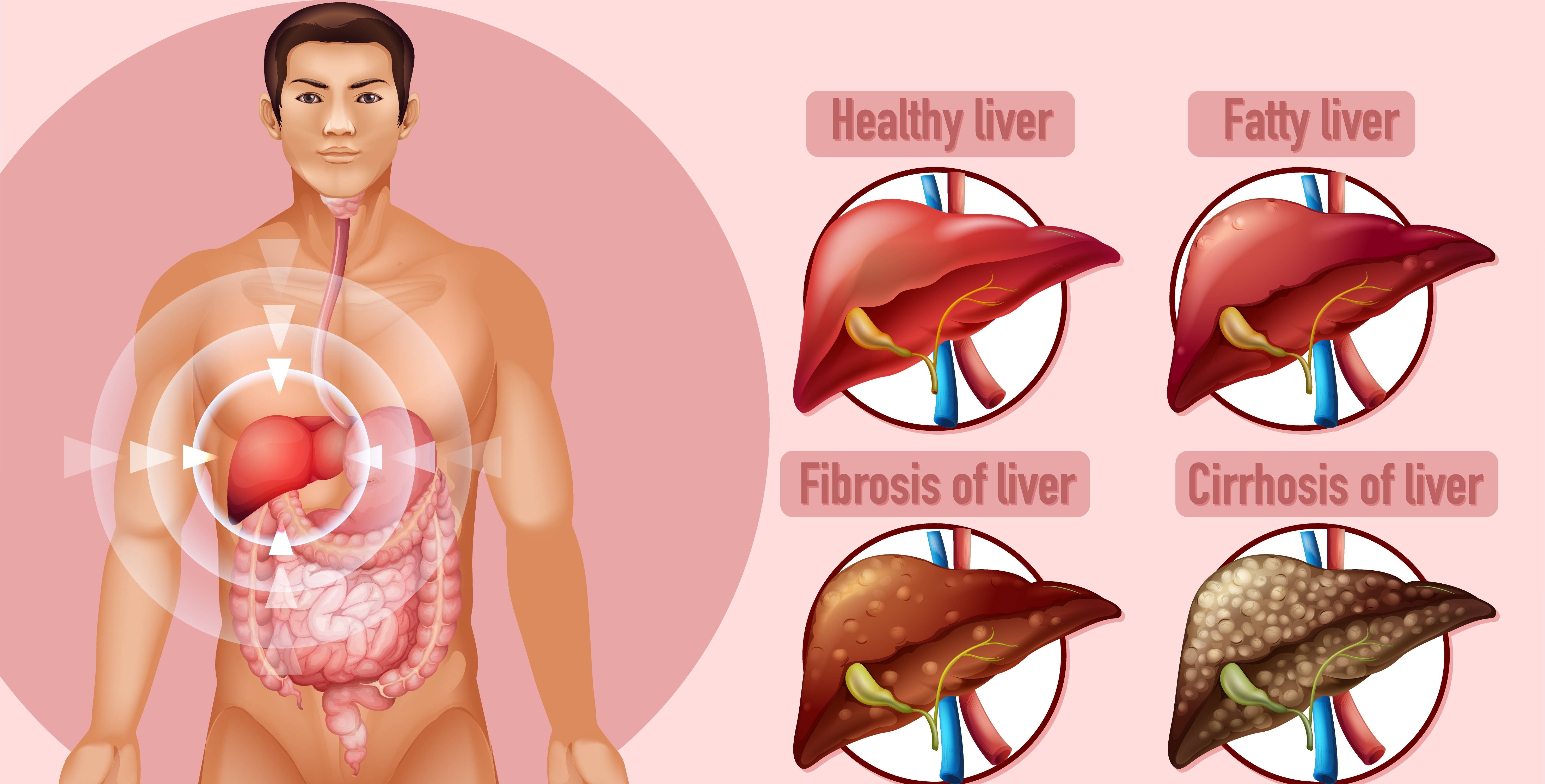 fatty liver remedies