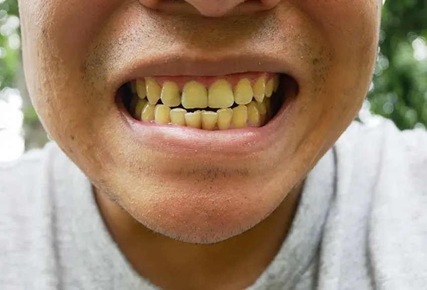 One Solution for Mouth Ulcers Gum Bleeding and Sensitivity Chirchita Leaves