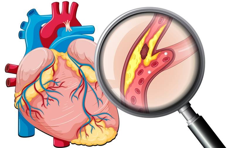 reduce bad cholesterol naturally