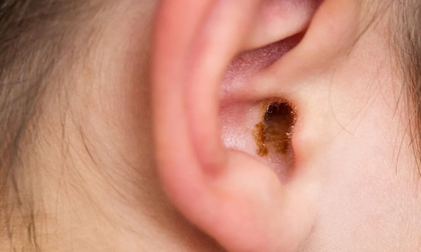 Safe Home Methods to Clean Your Child Ears