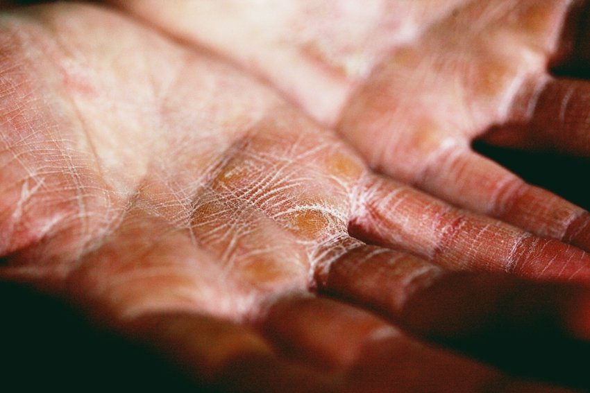 Top 10 Causes of Dry Skin and How to Prevent It
