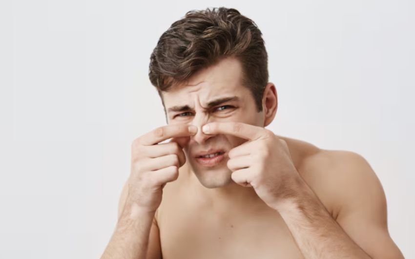 Blackheads,