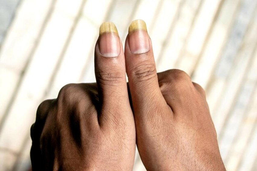 Why Are Your Nails Turning Yellow