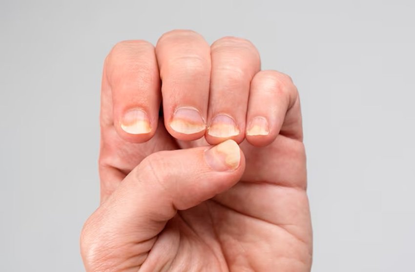 Yellow Nails