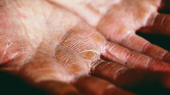 best remedies for dry skin