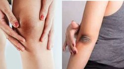 कोहनी और घुटनों के कालेपन को कैसे दूर करें? बहुत काम के हैं ये घरेलू उपाय