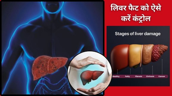 Myths of Fatty Liver,Myth 1: Fatty liver is caused by eating fat,Fatty liver is harmless