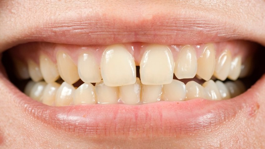 long and spaced teeth