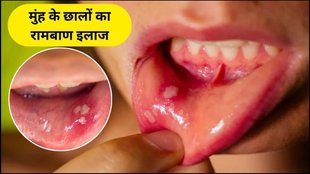 Remedies to treat mouth ulcers, how to cure mouth ulcers, remedies to cure mouth ulcers, types of mouth ulcers, what to eat after mouth ulcers