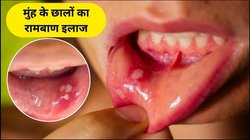 बार-बार हो जाते हैं मुंह में छाले तो खाएं ये 5 फूड्स, शरीर में हो सकती है इस विटामिन की कमी