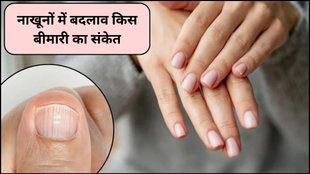 nail changes, subungual melanoma, nail health and diseases, Beau’s lines, clubbing nails, fungal infection, nails, infection, cancer, Liver, nakhun par Nishan kis bimari ka sanket, nails indicate, nakhun par Nishan