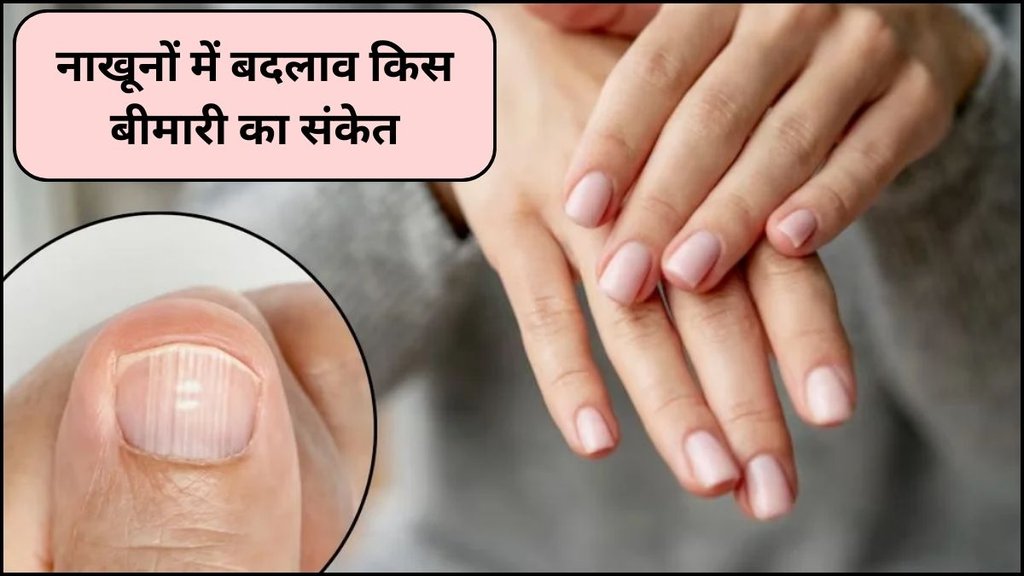 nail changes, subungual melanoma, nail health and diseases, Beau’s lines, clubbing nails, fungal infection, nails, infection, cancer, Liver, nakhun par Nishan kis bimari ka sanket, nails indicate, nakhun par Nishan