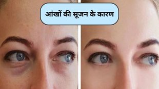 puffy eyes symptoms, causes of puffy eyes, natural remedies for puffy eyes, eye puffiness causes, eye swelling causes