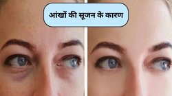 बार-बार सूज जाती हैं आंखें, जानिए कारण और नेचुरल उपचार