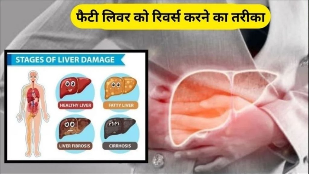 reverse fatty liver, resistant starch, reduce liver fat, liver health, gut microbiome, non-alcoholic fatty liver disease, dietary fiber, beneficial gut bacteria
