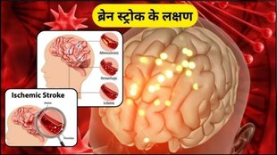 brain stroke, stroke symptoms, preventive measures for stroke, treatment for stroke, stroke awareness, Stroke, accidents, Ischemic strokes, Hemorrhagic strokes, Transient Ischemic Attack, stroke signs