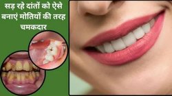 ये 2 चीजें दांतों पर जमी पीली परत को करेंगी साफ, दांतों को मिलेगी मजबूती, एक्सपर्ट ने बताया कैसे करें इस्तेमाल