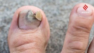 Ayurvedic remedies for nails