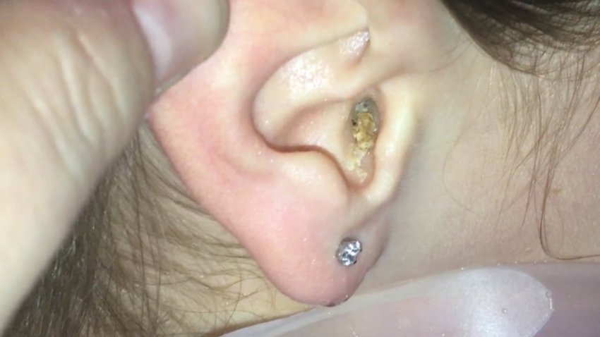 Best Home Remedies to Remove Earwax Naturally