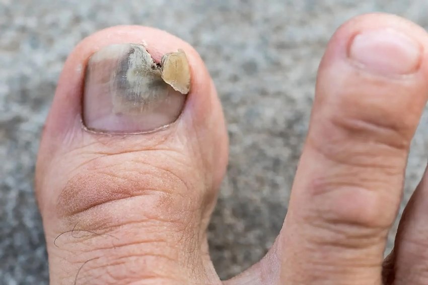Black or Fungal Nails Heal Them Naturally in Just 15 Days