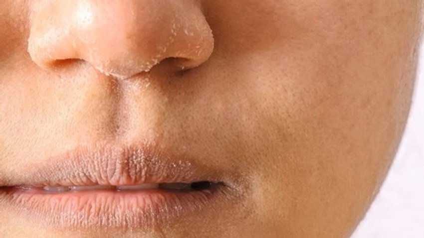 Cracked Lips You Might Be Deficient in This Vital Vitamin