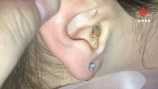 Easy ways to remove earwax at home
