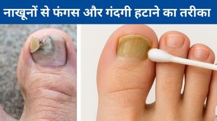Toenail fungus | How do I get rid of fungus on my toenails | Best way to clean dirty nails naturally
