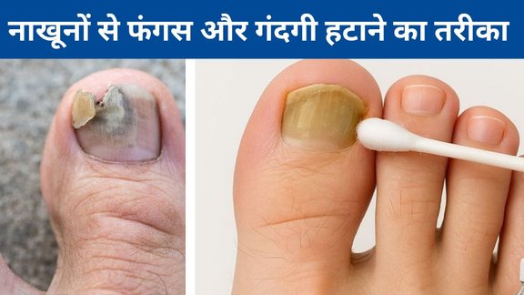 Toenail fungus | How do I get rid of fungus on my toenails | Best way to clean dirty nails naturally