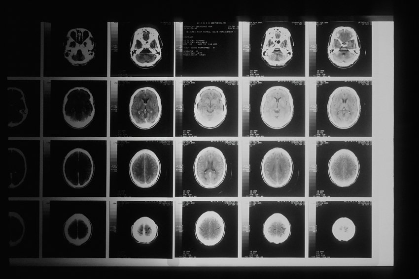 Lack of Sleep Can Make Your Brain Eat Its Own Cells Study Reveals Alarming Facts