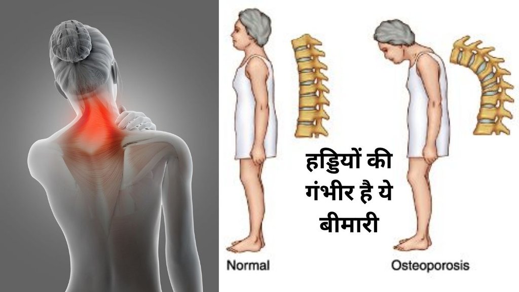 Know the signs and treatment of this bone weakening disease, Osteoporosis, Osteoporosis symptoms you shouldn’t ignore, Know the signs and treatment of this bone weakening disease, Osteoporosis, Osteoporosis symptoms you shouldn’t ignore,