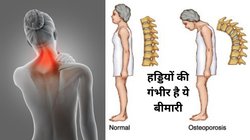 हड्डियों को गला देती है ये बीमारी, हाथ-पैरों और दांतों पर भी दिखता है इसका असर, जानिए Osteoporosis की पहचान और बचाव