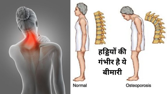 Know the signs and treatment of this bone weakening disease, Osteoporosis, Osteoporosis symptoms you shouldn’t ignore,