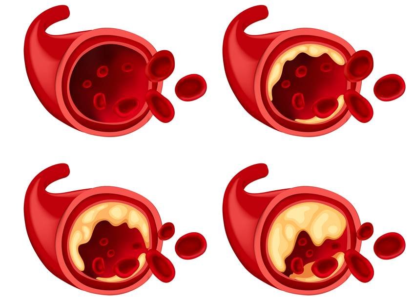 antioxidants for arteries