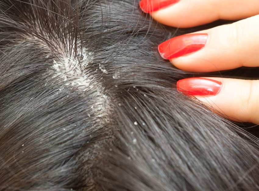 Reduced blood flow to the scalp affects hair growth