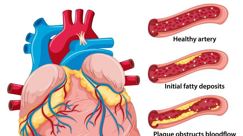 lower LDL naturally