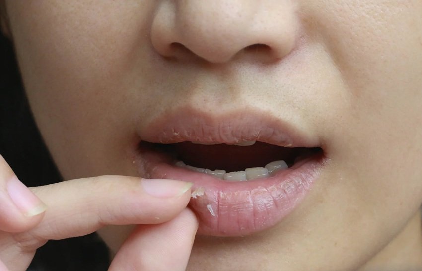 Vitamin B12 Deficiency Symptoms Why Your Lips Are Dry Cracked and Painful
