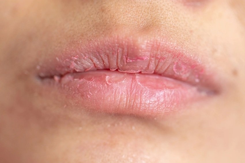 Vitamin B12 Deficiency The Hidden Reason Behind Dry and Chapped Lips