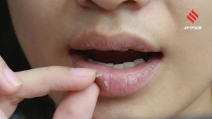 causes of dry and peeling lips