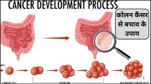 bowel cancer prevention tips, colon cancer risk reduction, healthy lifestyle habits, colorectal cancer prevention tips