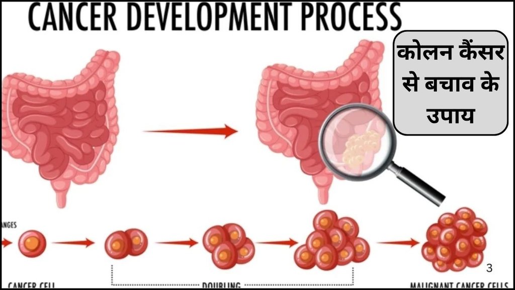 bowel cancer prevention tips, colon cancer risk reduction, healthy lifestyle habits, colorectal cancer prevention tips