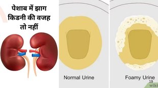 Is Foamy urine can cause of kidney damage, Foamy urine, kidney damage, protein leakage, persistent foam, dehydration, swelling, blood pressure,