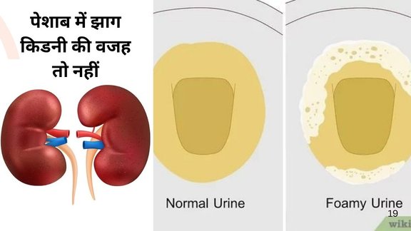 Is Foamy urine can cause of kidney damage, Foamy urine, kidney damage, protein leakage, persistent foam, dehydration, swelling, blood pressure,