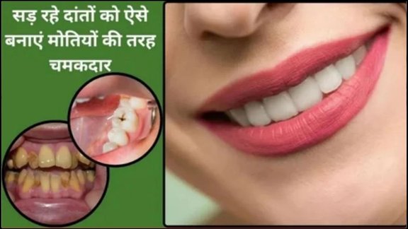 Remedies for whitening yellow teeth, what to apply to remove yellow layer on teeth, home remedies for whitening teeth, what foods to apply to teeth make teeth stronger