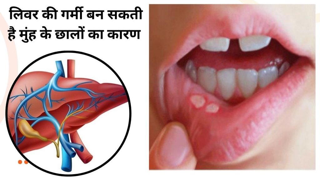 liver heat mouth ulcers treatment, mouth ulcers due to liver heat, ayurvedic remedies for liver heat, home remedies for mouth ulcers liver heat mouth ulcers treatment, mouth ulcers due to liver heat, ayurvedic remedies for liver heat, home remedies for mouth ulcers