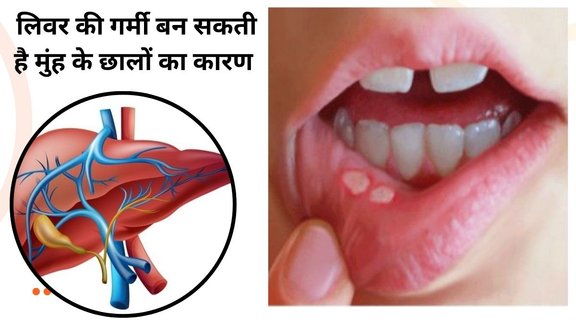 liver heat mouth ulcers treatment, mouth ulcers due to liver heat, ayurvedic remedies for liver heat, home remedies for mouth ulcers