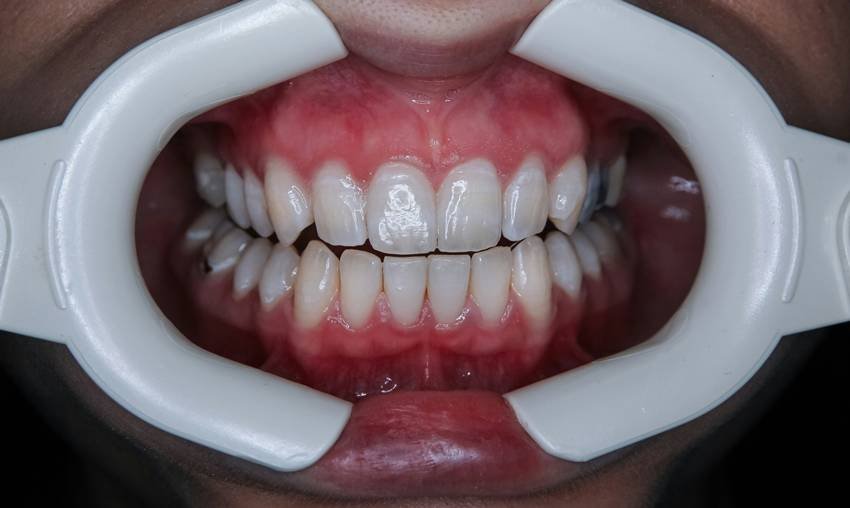 ayurvedic oral care