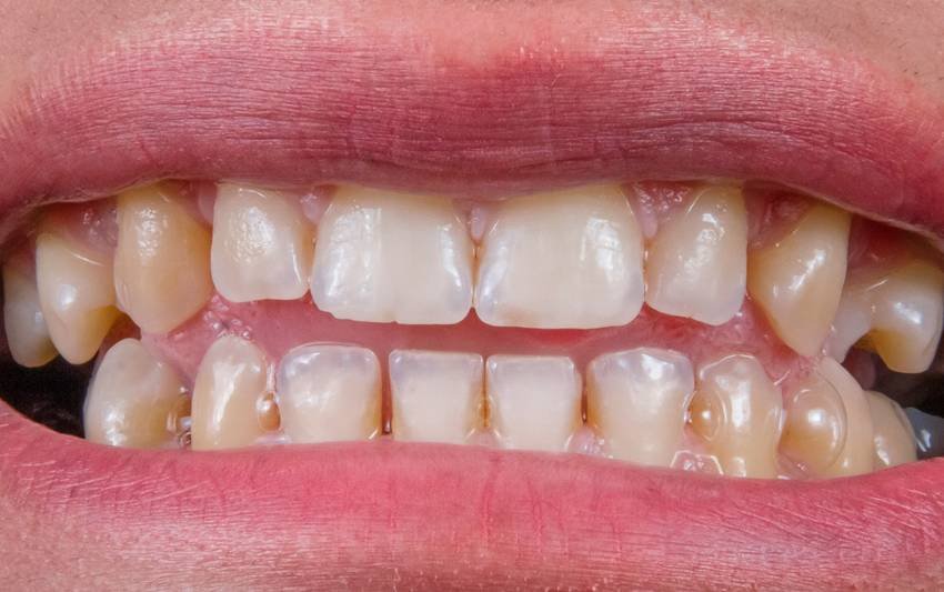 teeth whitening home remedy