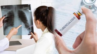 tuberculosis